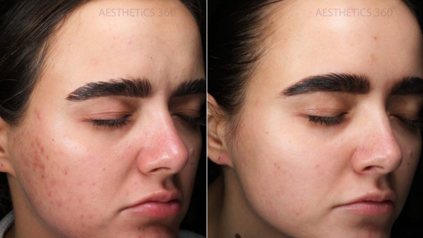 Before and after of a saltfacial