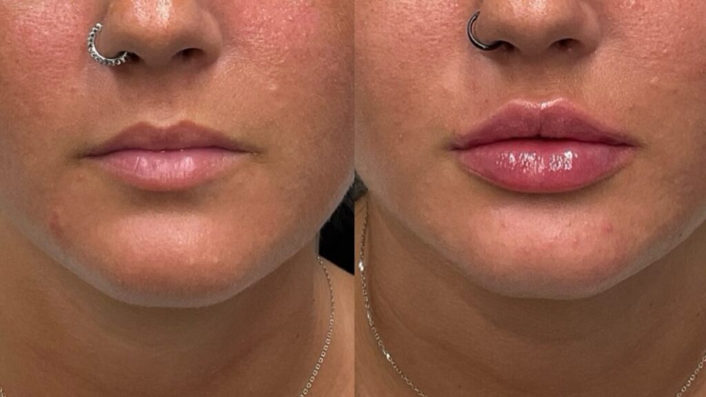 Before and after lip filler comparison photos