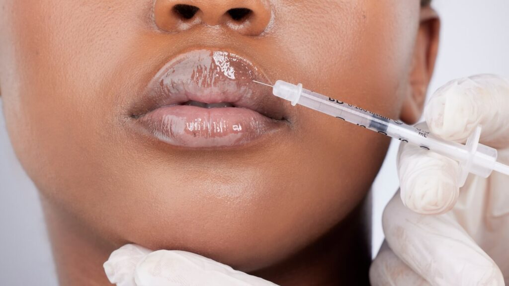 Person getting lip filler straight view