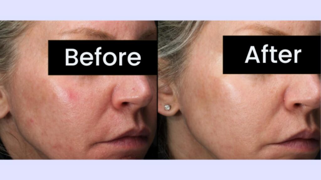 Before and after BBL Hero photos