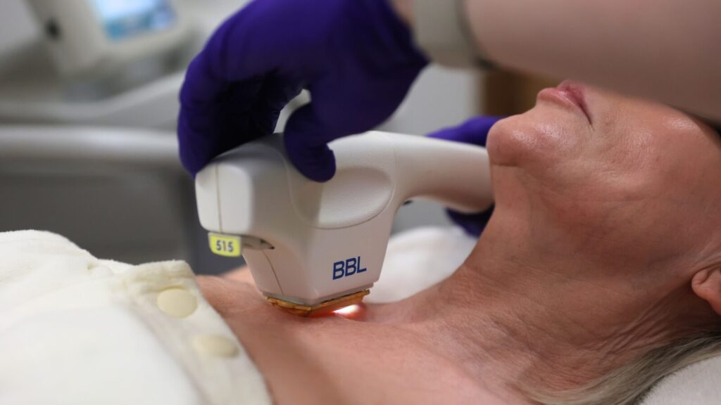 Patient receiving BBL Hero treatment on their chest