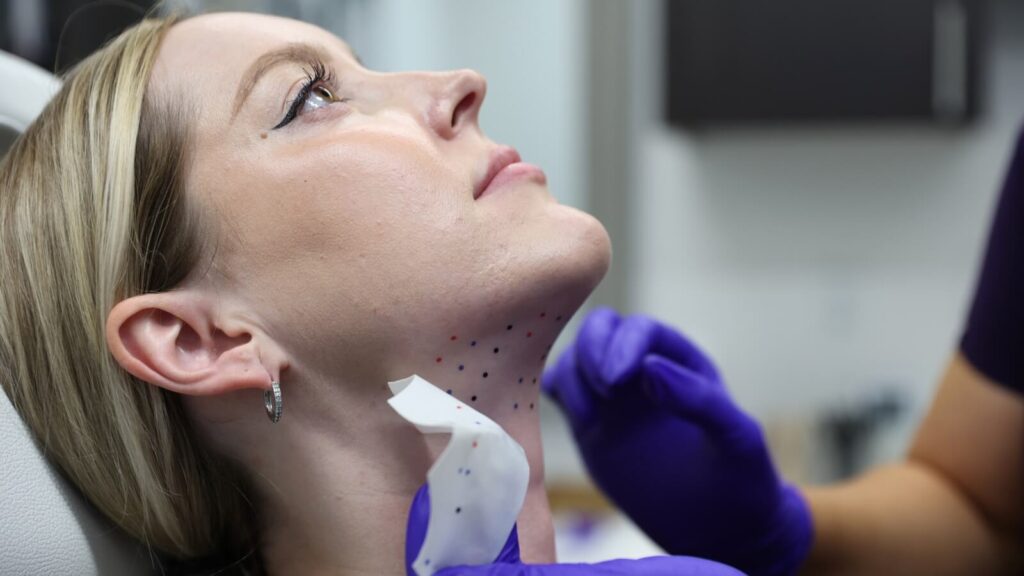 Person getting marked up for a Kybella injection