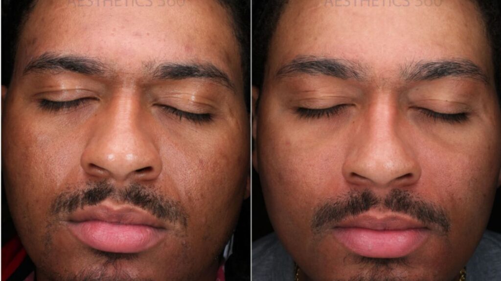Microneedling before and after