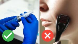 SkinPen versus dermarolling
