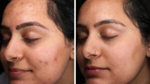 Before and after of the SaltFacial