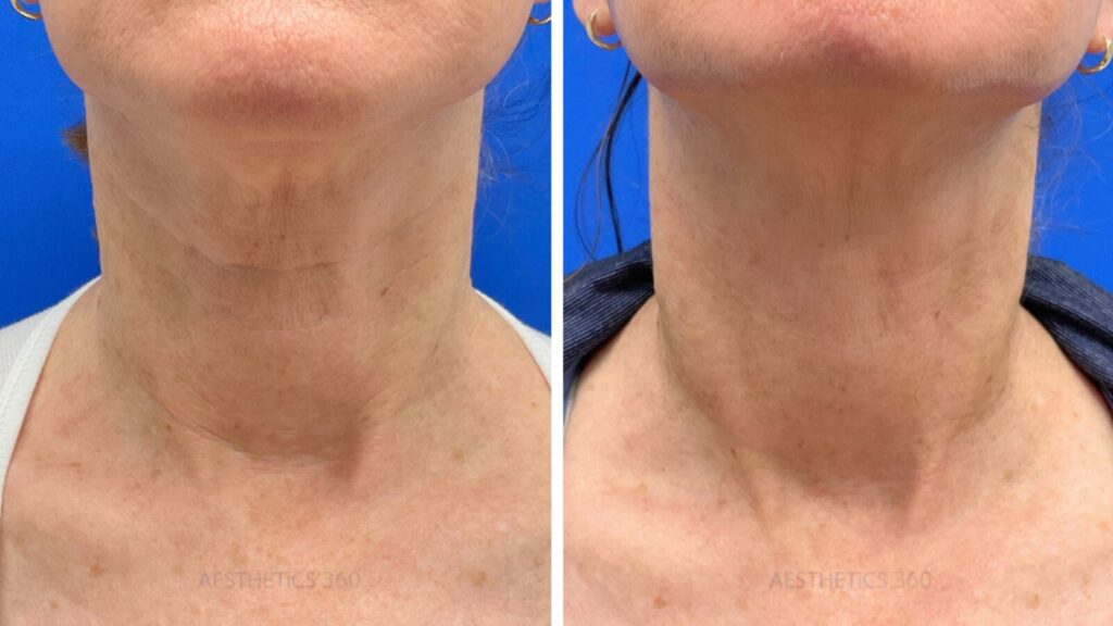 close up of person with botox on neck before and after