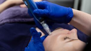 Microneedling treatment