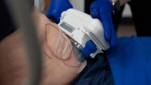 Person getting Coolsculpting on their stomach