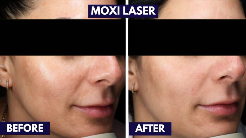 moxi laser before and after