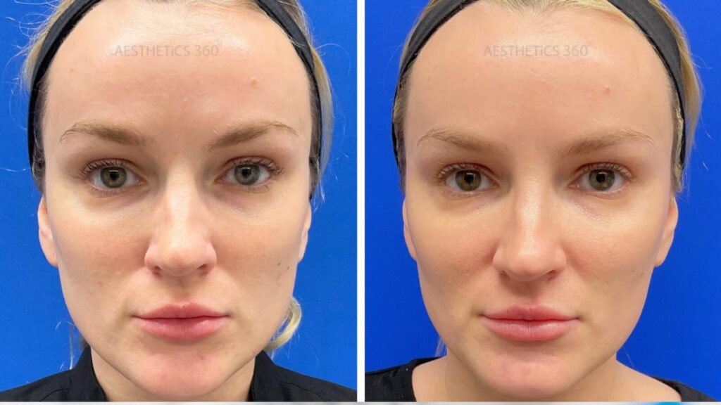 Before and after sculptra treatment