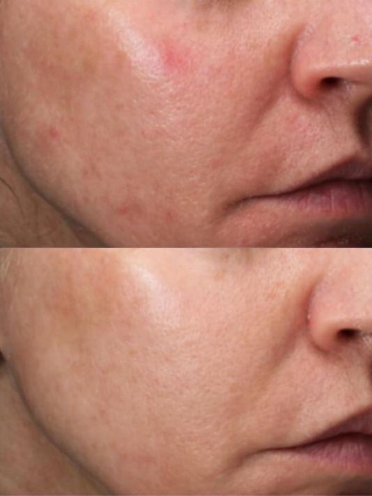 Preview Image BBL Hero