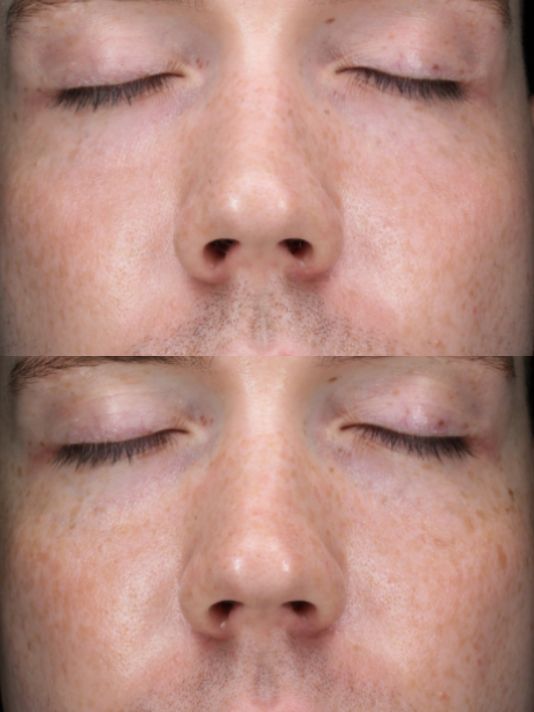 Preview Image BBL Photofacial