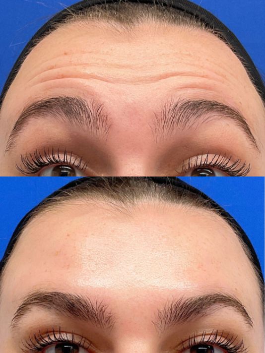 Preview Image of Botox