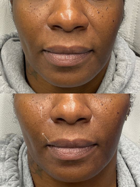 Preview Image Cheek Midface Filler