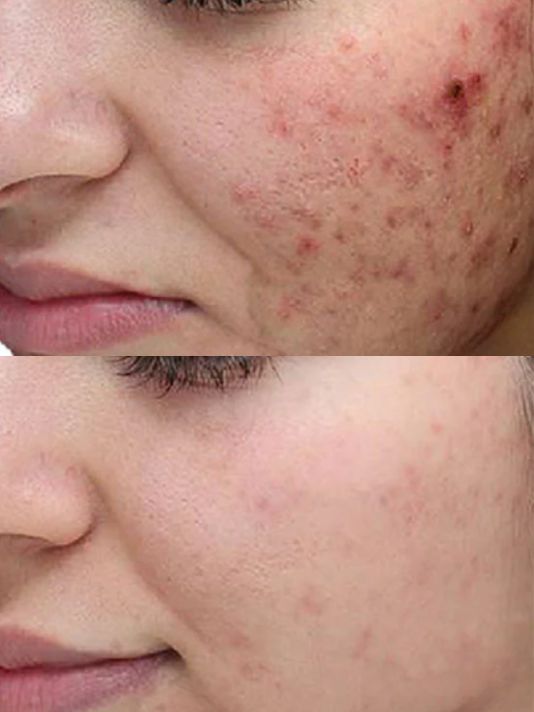Preview Image Chemical Peel