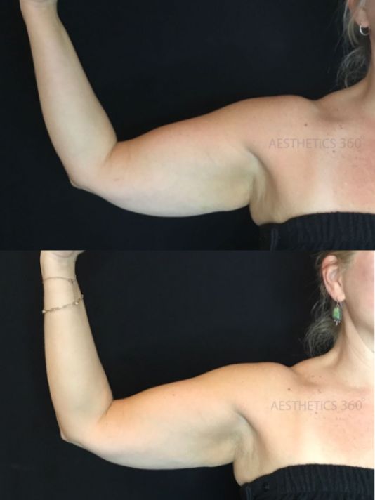 Preview Image for Coolsculpting