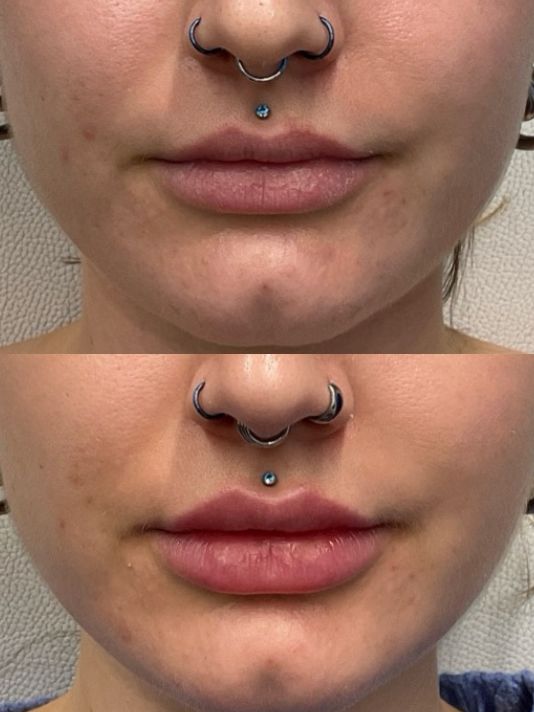 Lip Filler Before and After Image Preview in Downtown Milwaukee
