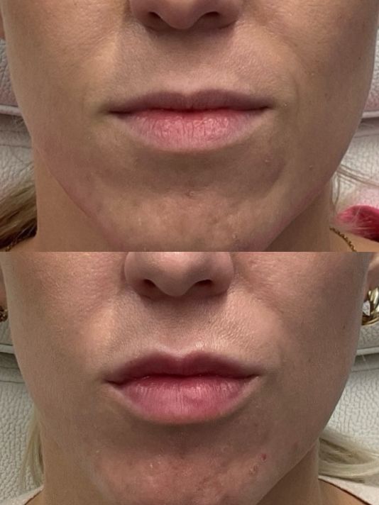 Lip Filler Before and After Image Preview in Downtown Milwaukee Wisconsin
