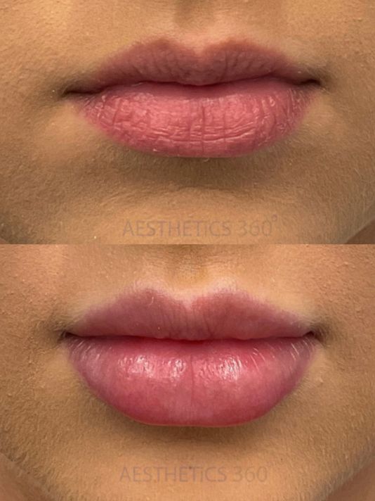 Lip Filler Results Before and After Preview Image