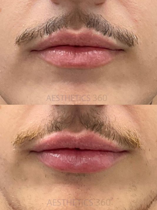 Lip Filler Before and After Image Preview in Milwaukee Wisconsin