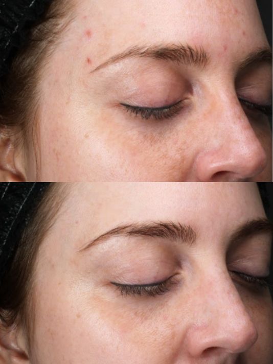 Preview Image Microneedling