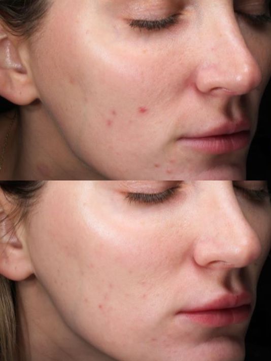 Preview Image Moxi Laser Treatement