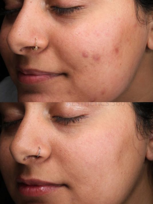 Preview Image of Saltfacial