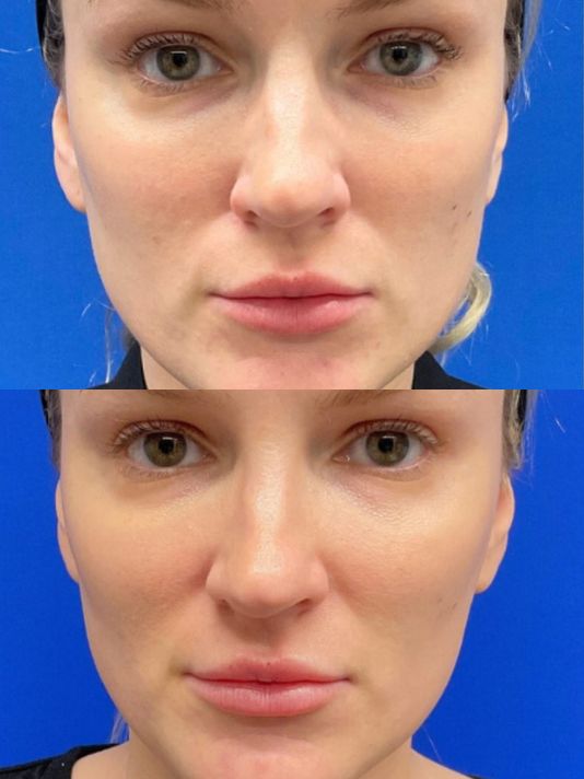 Preview Image of Sculptra