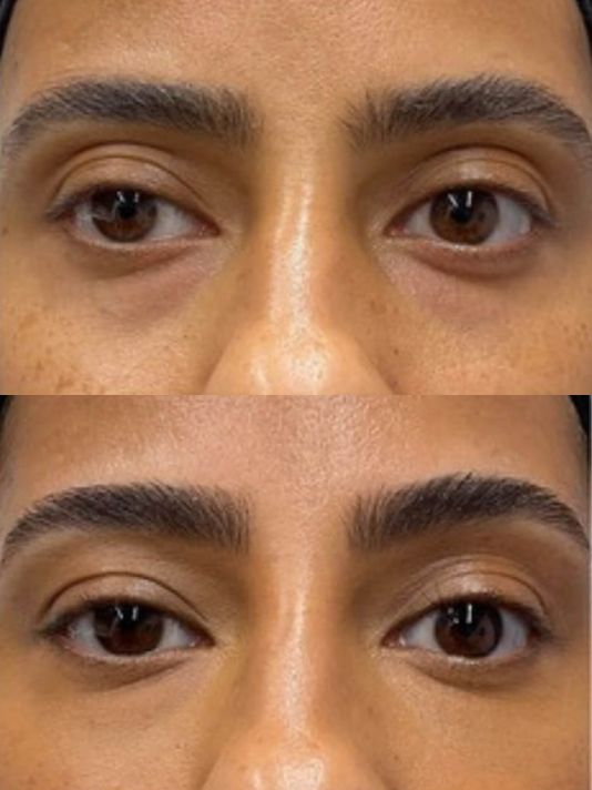 Preview Image Under Eye Filler