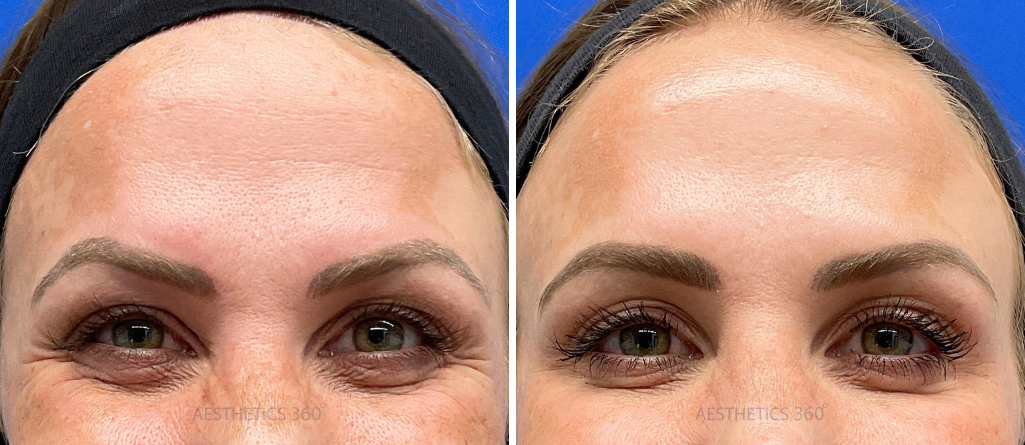 Botox crow's feet-before and after results in Milwaukee WI