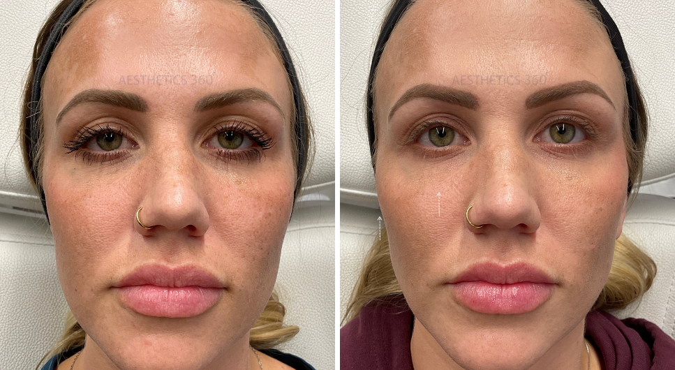 close ups of a woman before and after her eye bag treatment in Milwaukee