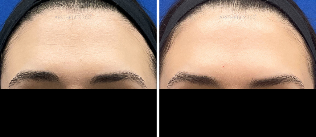 Daxxify forehead-before and after results in Brookfield WI