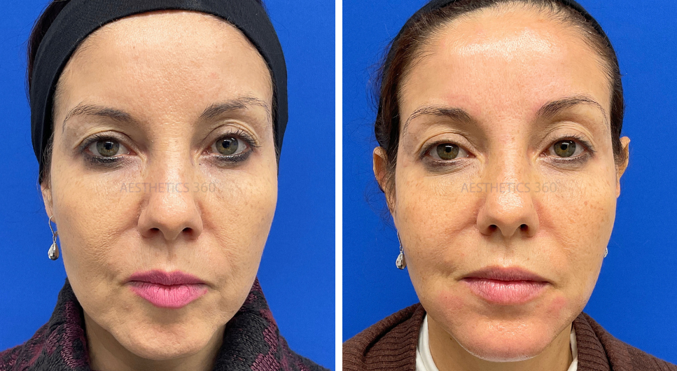 Lower Face Filler-before and after results in Milwaukee WI