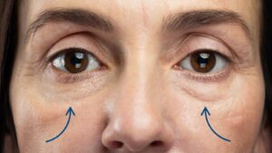 Arrows pointing to under-eye bags