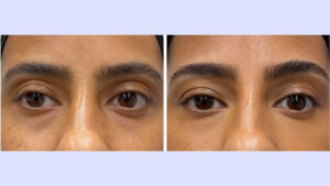 Before and after under eye filler photo
