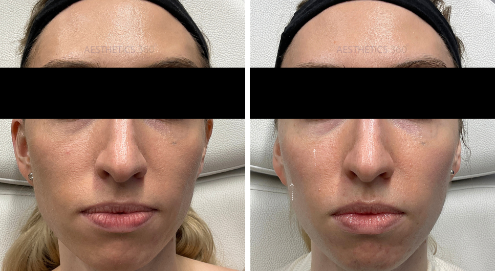 Sculptra-before and after results in Milwaukee WI