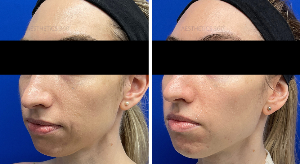 Sculptra-before and after results in Milwaukee WI