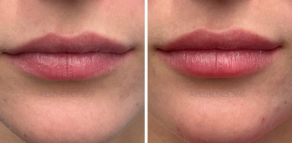 Lip Filler-before and after results in Pewaukee WI