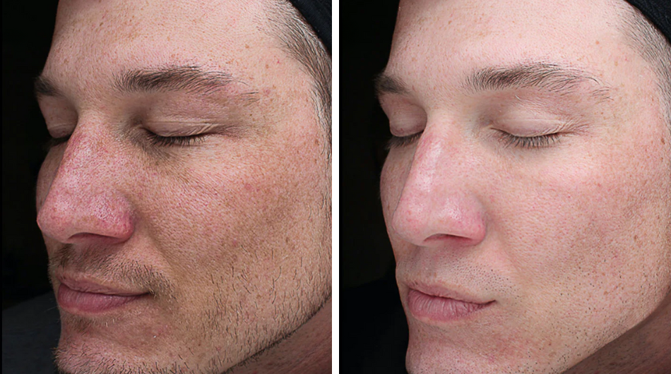 Chemical Peel-male before and after results in Milwaukee WI