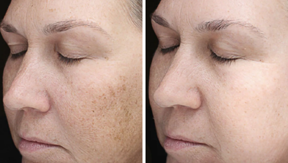 Chemical Peel-before and after results in Brookfield WI