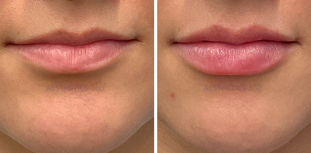 Lip Filler-before and after in Mequon WI