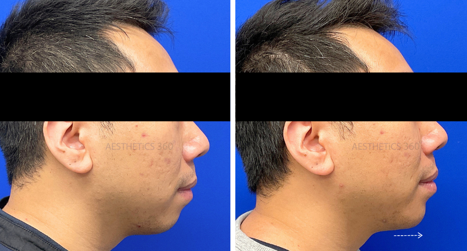 Chin Filler-male before and after results in Milwaukee WI