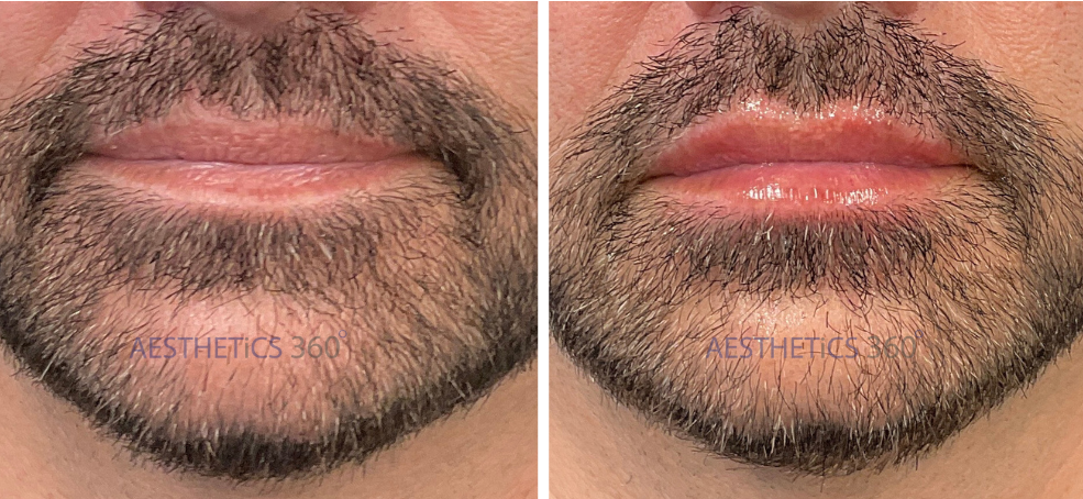 Lip Filler-male before and after results in Milwaukee WI