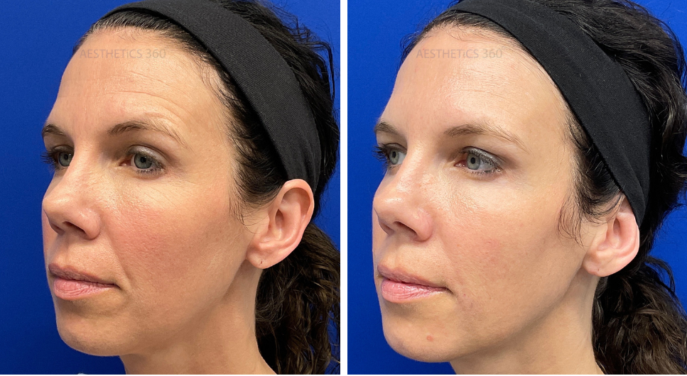 Cheek filler-before and after results in Milwaukee WI