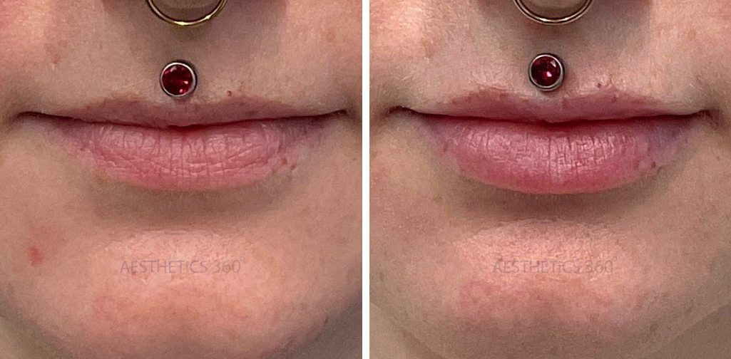 Lip Filler-Before and After Results in Milwaukee WI