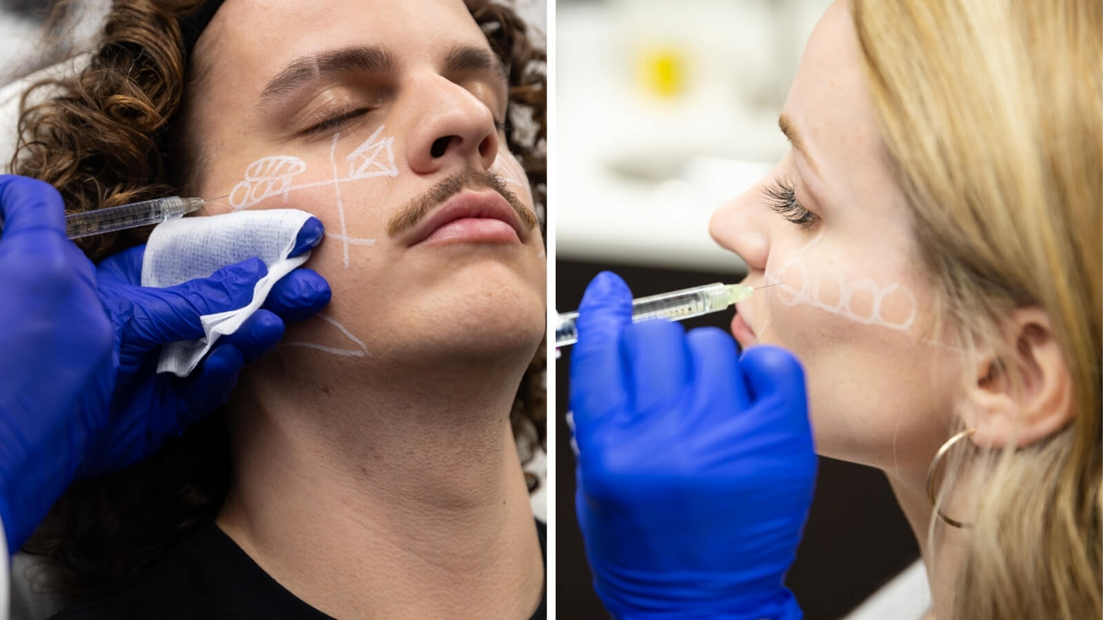 split photo of Male recieving fillers and a female recieving fillers