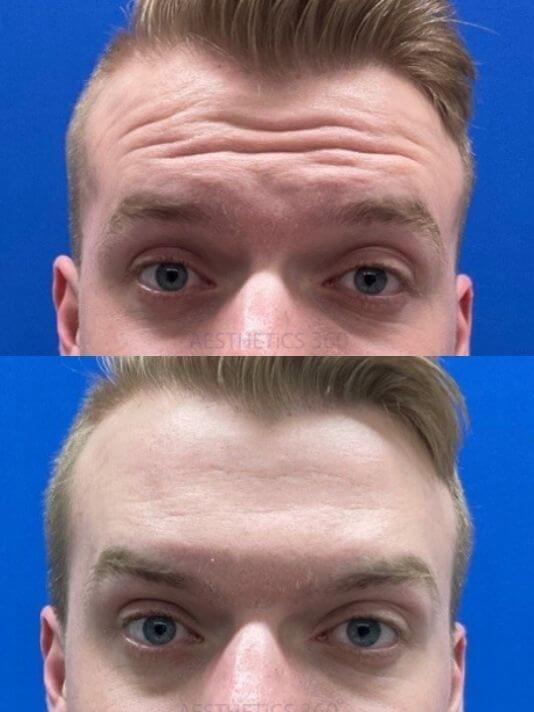 man getting boxtox on forehead before and after picture