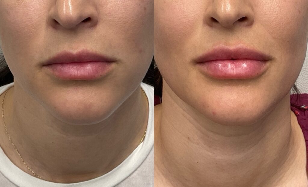 Pt. AS lip filler 52