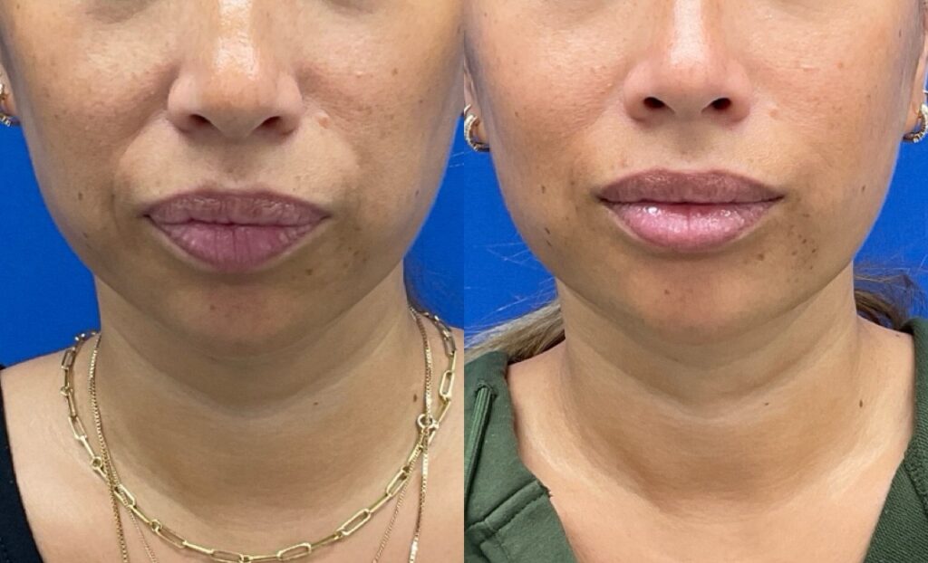 Pt. AS lip filler for hydration 51