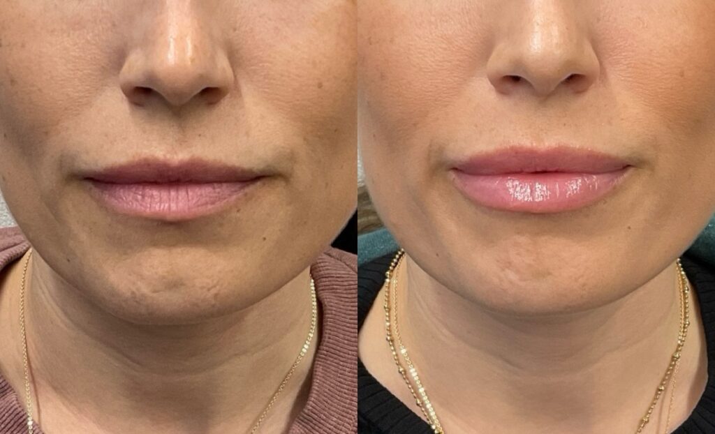 Pt. BD lip filler 53